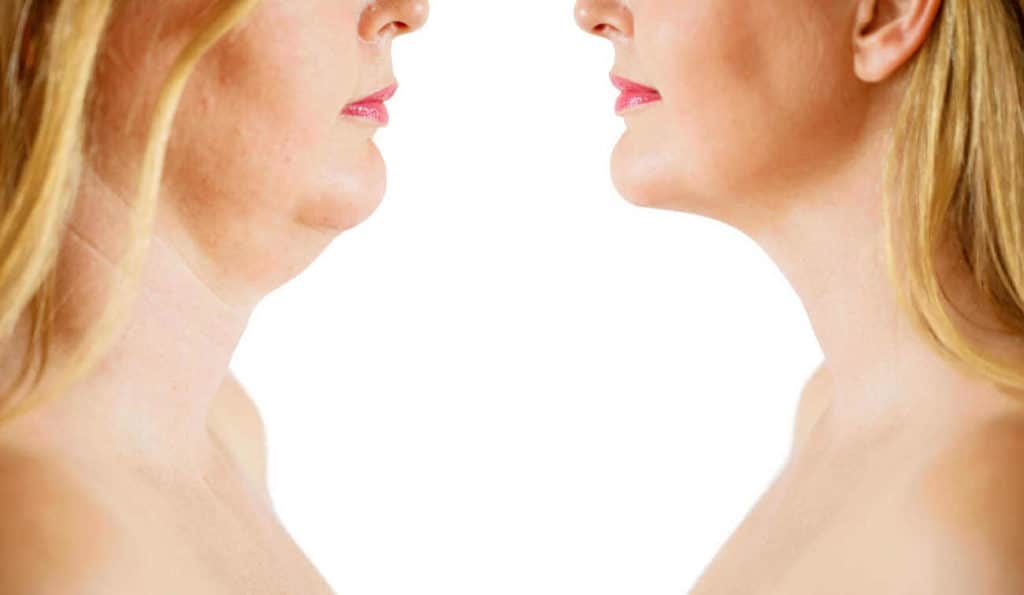 Double Chin treatment Kentish Town before and after results