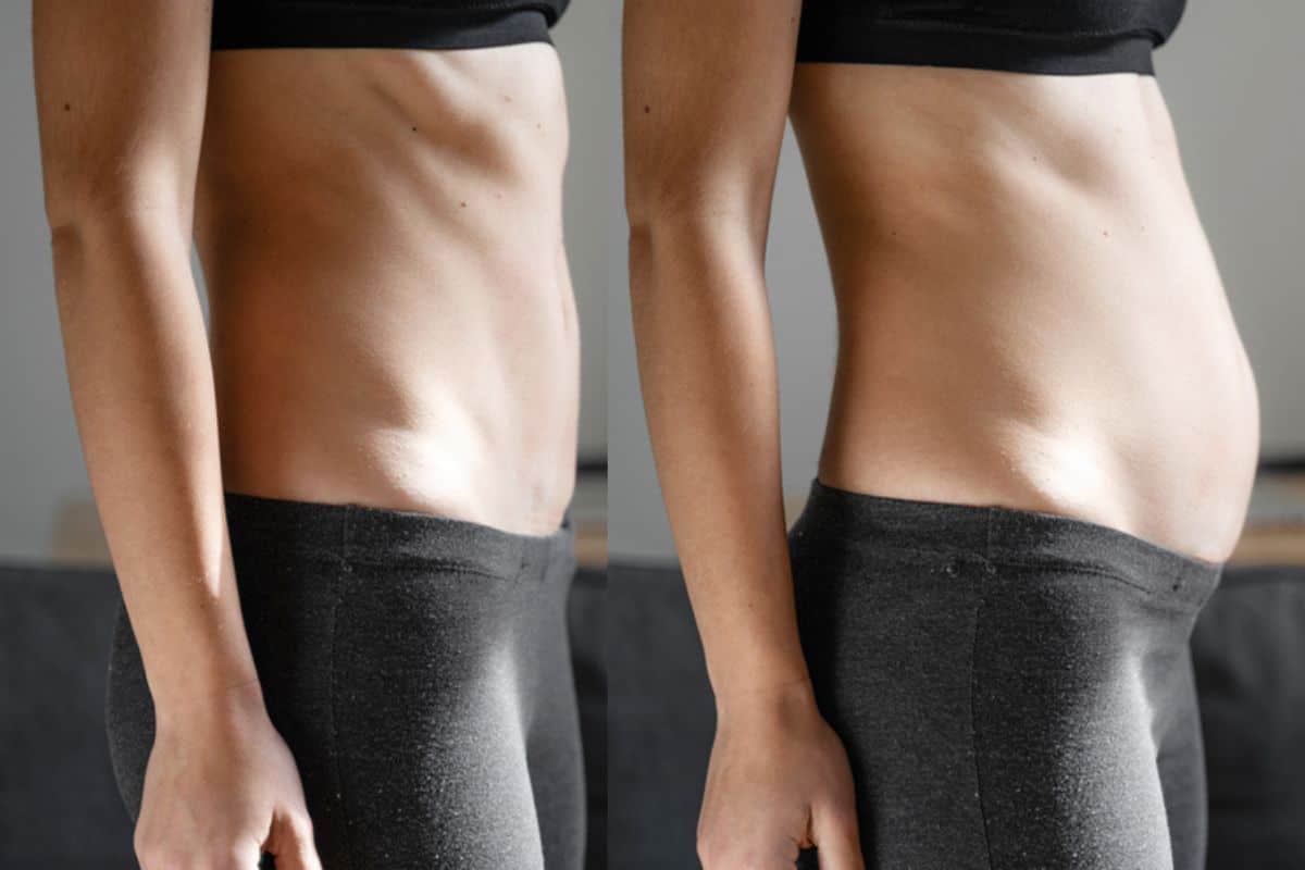 How long does diastasis recti take to improve Kentish Town?