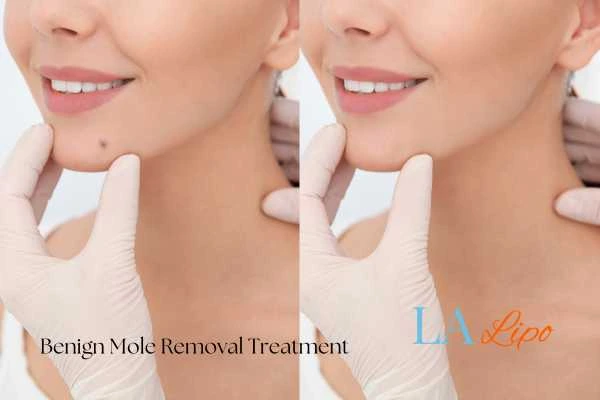 woman's before and after mole removal Kentish Town results