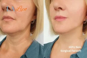 hi-fu for wrinkles Kentish Town before and after results