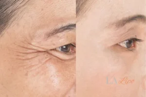 Before and after results of woman - HI-fu wrinkles reduction treatment Kentish Town