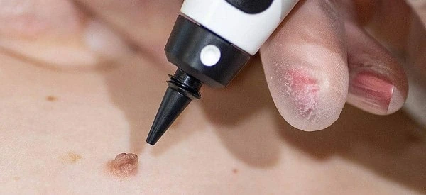 skin tag removal using cryopen Kentish Town