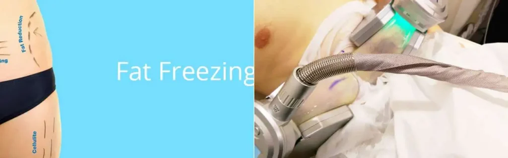 Fat freezing Kentish Town on multiple areas of the body