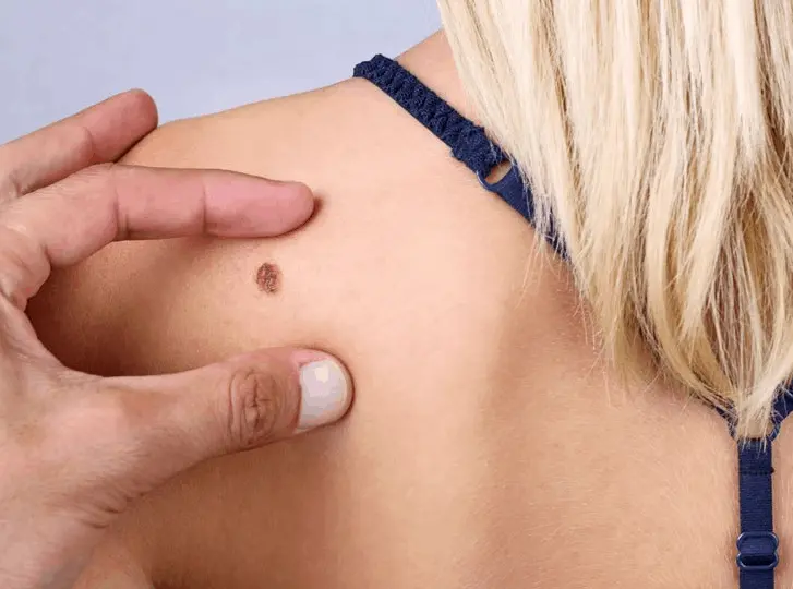 woman having mole removal Kentish Town consultation before treatment.