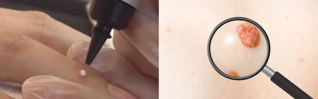 Cryopen for mole removal Kentish Town - speak to our team today!