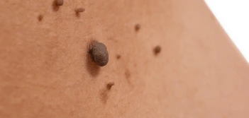 image of a skin tag Kentish Town