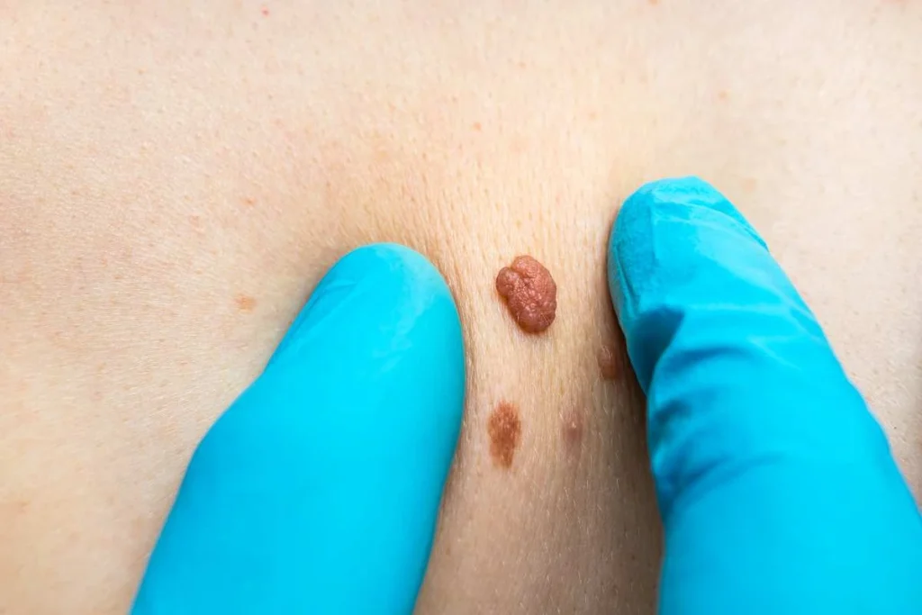 Consultant examining a skin tag Kentish Town