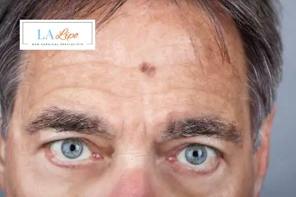 Solar Lentigo Removal Kentish Town image of man with mark on his forehead