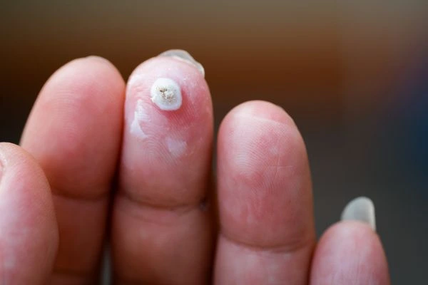 wart on person finger - cryotherapy to treat from LA LIPO Kentish Town