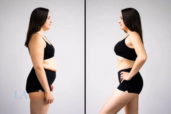 Picture of womans before and after using LA-EMS body sculpting to improve her core strength Kentish Town