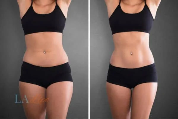 before and after results of non-surgical treatment to help a woman's body image and mental health Kentish Town