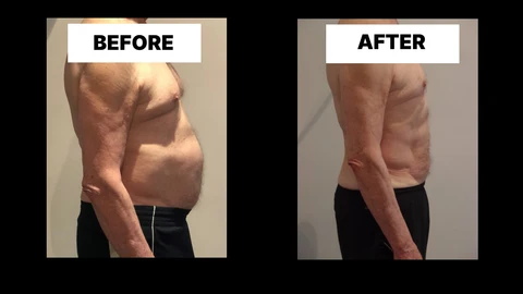 What Symptoms Can Diastasis Recti Cause in Men? Weak Core, Back Pain and Poor Posture Kentish Town